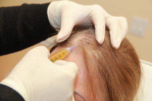 мезотерапия волос1
